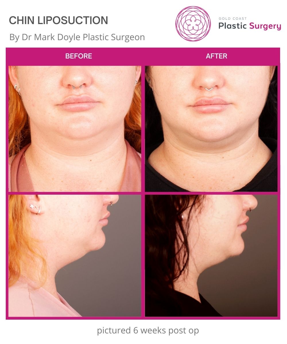 Chin And Neck Liposuction Gold Coast Brisbane Dr Mark Doyle