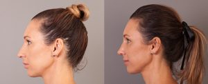 Nose job gallery, image 08, before and after, side view