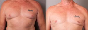 Male breast reduction before and after, image 01, front view