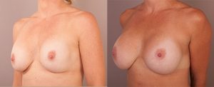Patient 10, breast augmentation before and after, image 01
