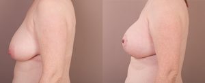 breast lift before and after - image 0016