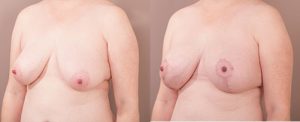breast lift before and after - image 0017