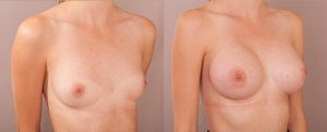 Image 14, breast augmentation surgery, before and after photo