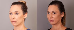 A female rhinoplasty patient, before and after photos, image 09, angle view