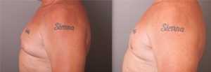 Patient before and after male breast reduction, image 02, side view