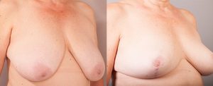 breast lift before and after