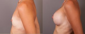 Patient 03 before and after breast implants surgery, image 03