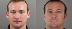 Otoplasty surgery before and afters, image 05, adult male patient, front view