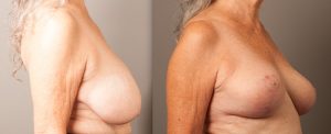 breast reduction before and afters - image 003