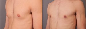 Surgery for gynaecomastia, image 03, patient before and after the procedure
