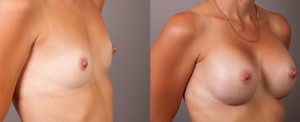 Breast implants, patient 04 before and after, photo 02