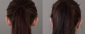 Otoplasty gallery, female patient before and after, image 03, back view