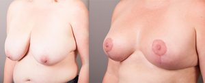 breast reduction - before and after - image 004