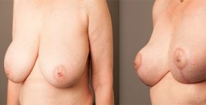 real patient - breast reduction - before and after - image 006 - dr doyle