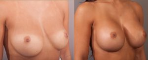 Breast implants before and after gallery, patient 07, image 02, angle view