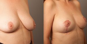breast reduction surgery - before and afters - image 007