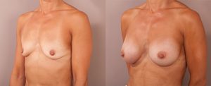 Breast enlargement before and after, patient 08, angle view