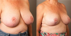008 - breast reduction before and afters - dr doyle gold coast