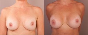 Patient 09 before and after breast augmentation surgery, image 01, front
