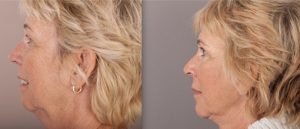 Facelift before and after, female patient, side view, image 01