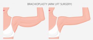 brachioplasty arm lift surgery cost medicare