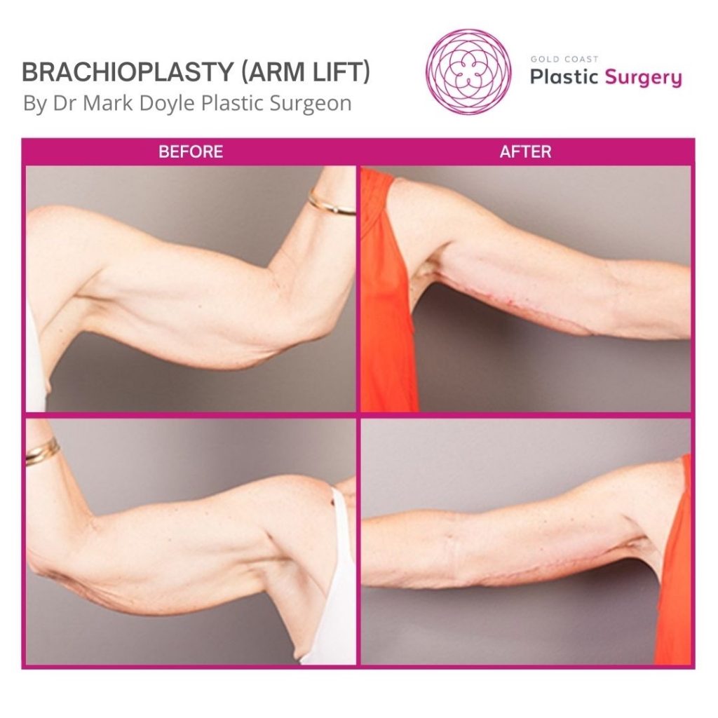 arm lift brachioplasty gold coast brisbane dr doyle plastic surgeon