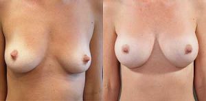 Breast implants, patient's photo before & after surgery, Dr Doyle Gold Coast