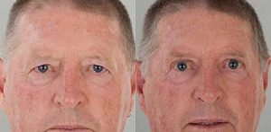 Eyelid Surgery before and after gallery, male patient, image 03, Dr Doyle Gold Coast