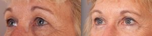 Eyelid surgery before and after, image 01