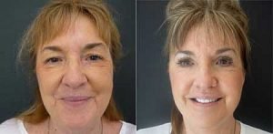 Before and after facelift, front view, image 01, Dr Doyle Gold Coast