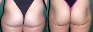 Liposuction to thighs, before and afters, image 06, back view