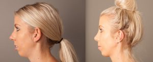 Rhinoplasty before and after, female patient, image 01