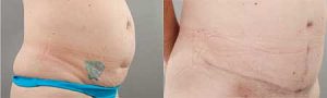 Tummy tuck results, image 01, before & afters gallery