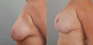 Image 10, breast lift, Gold Coast Plastic Surgery, side view
