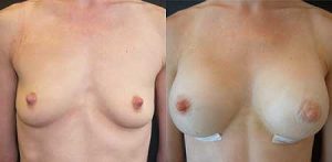 Breast augmentation with implants surgery, image 11