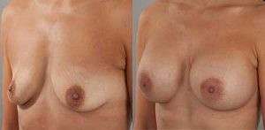 Breast implants surgery, patient before and after procedure, image 12