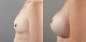 Breast augmentation before and after, image 13, side view