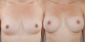 Breast augmentation plastic surgery, before and after gallery, image 14