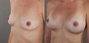 Breast implants before and after, image 15, surgery results