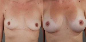 Breast enlargement (implants)with Dr Doyle, patient's image 16