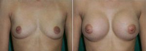 Breast implants surgery, image 18, before & afters gallery