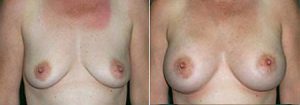 Breast enlargement, before & after, image 19