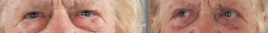 Patient before and after blepharoplasty with Dr Doyle, image 02