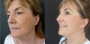 Patient before and after face lift at Gold Coast Plastic Surgery, image 02