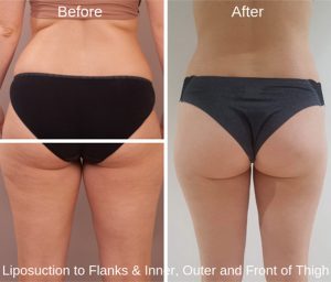 Patient before and after liposuction, image 02, real patient, Dr Doyle
