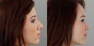 Rhinoplasty surgery with Dr Doyle, before and after gallery, image 10