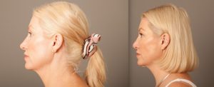 Nose job before and after, side view, image 02