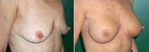 Image 20, breast augmentation before and after, Dr Doyle, Gold Coast