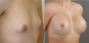 Image 22, breast augmentation gallery, Gold Coast Plastic Surgery