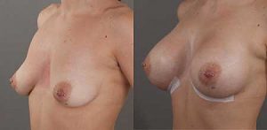 Image 03, breast implants, before & after, angle view